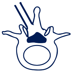 Microscopic Discectomy